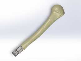 ���Źǹ����ϼ��� / Protese osseointegrada transhumeral