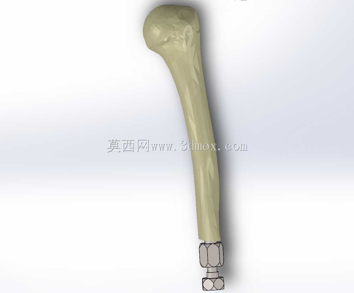 ���Źǹ����ϼ��� / Protese osseointegrada transhumeral