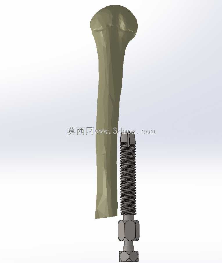 ���Źǹ����ϼ��� / Protese osseointegrada transhumeral