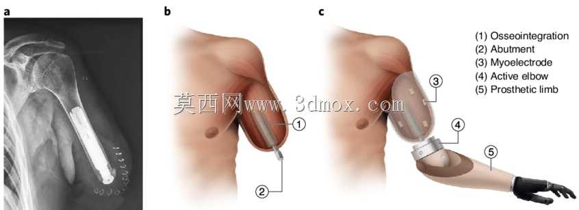 ���Źǹ����ϼ��� / Protese osseointegrada transhumeral