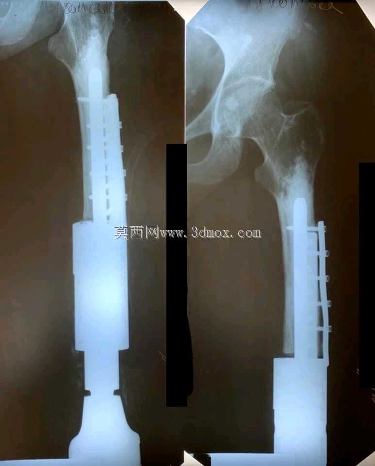 植入式重建系统