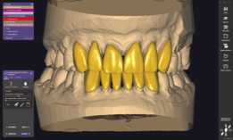 Exocad Galway 3.0ǰ����Ŀ