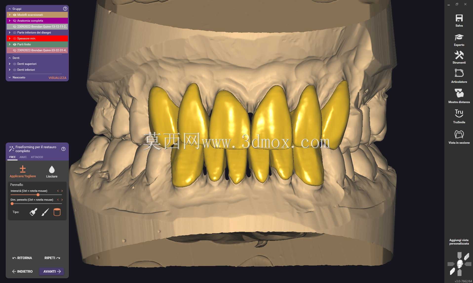 Exocad Galway 3.0ǰ����Ŀ