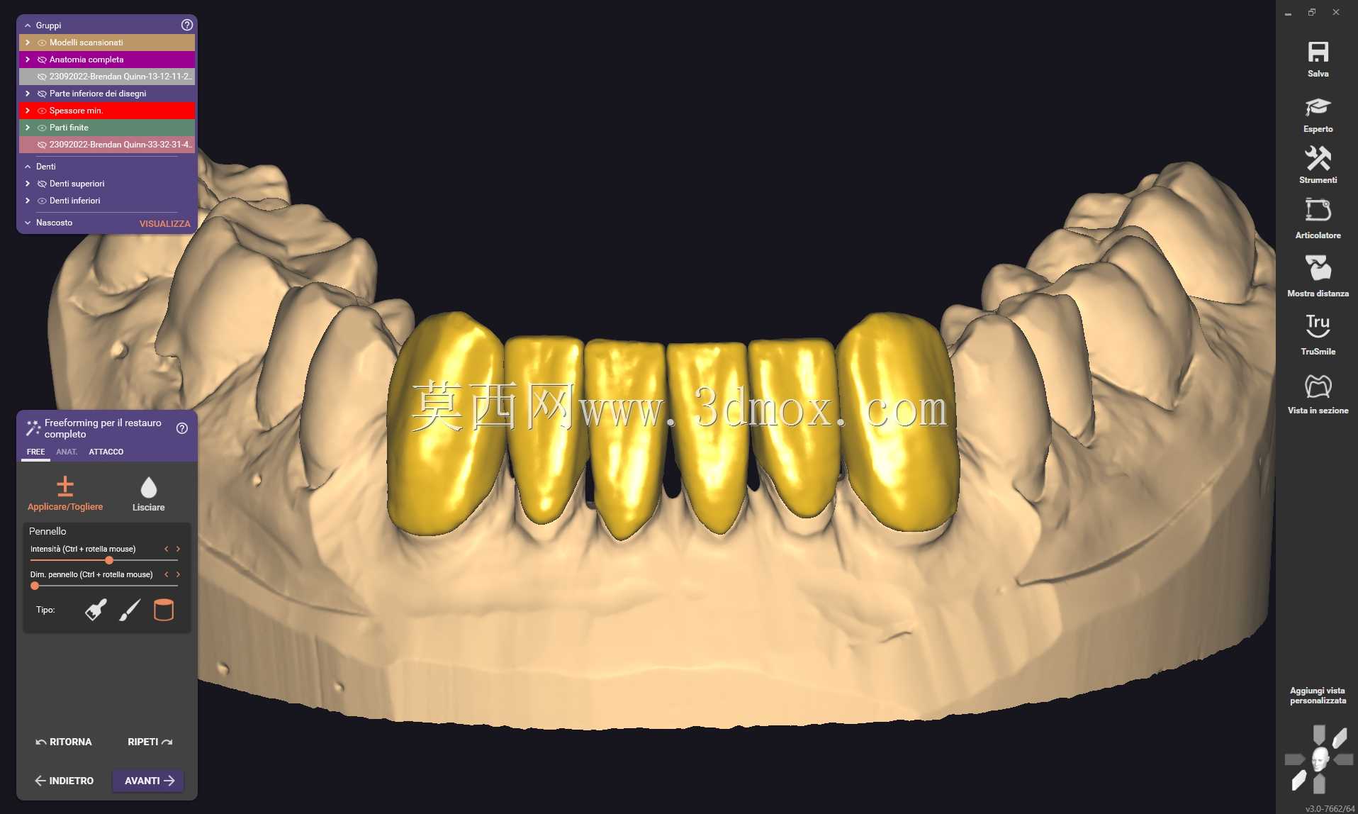 Exocad Galway 3.0ǰ����Ŀ