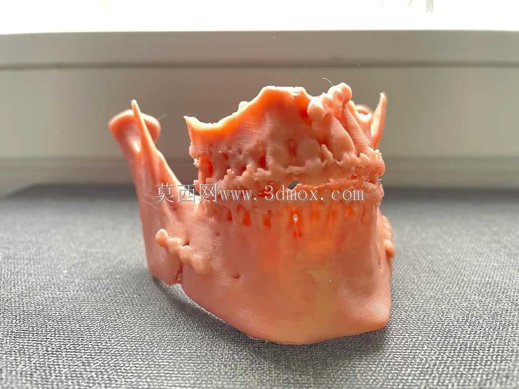 Bijaw手术后的上颌和下颌