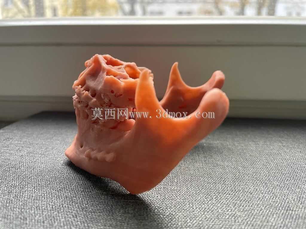 Bijaw手术后的上颌和下颌