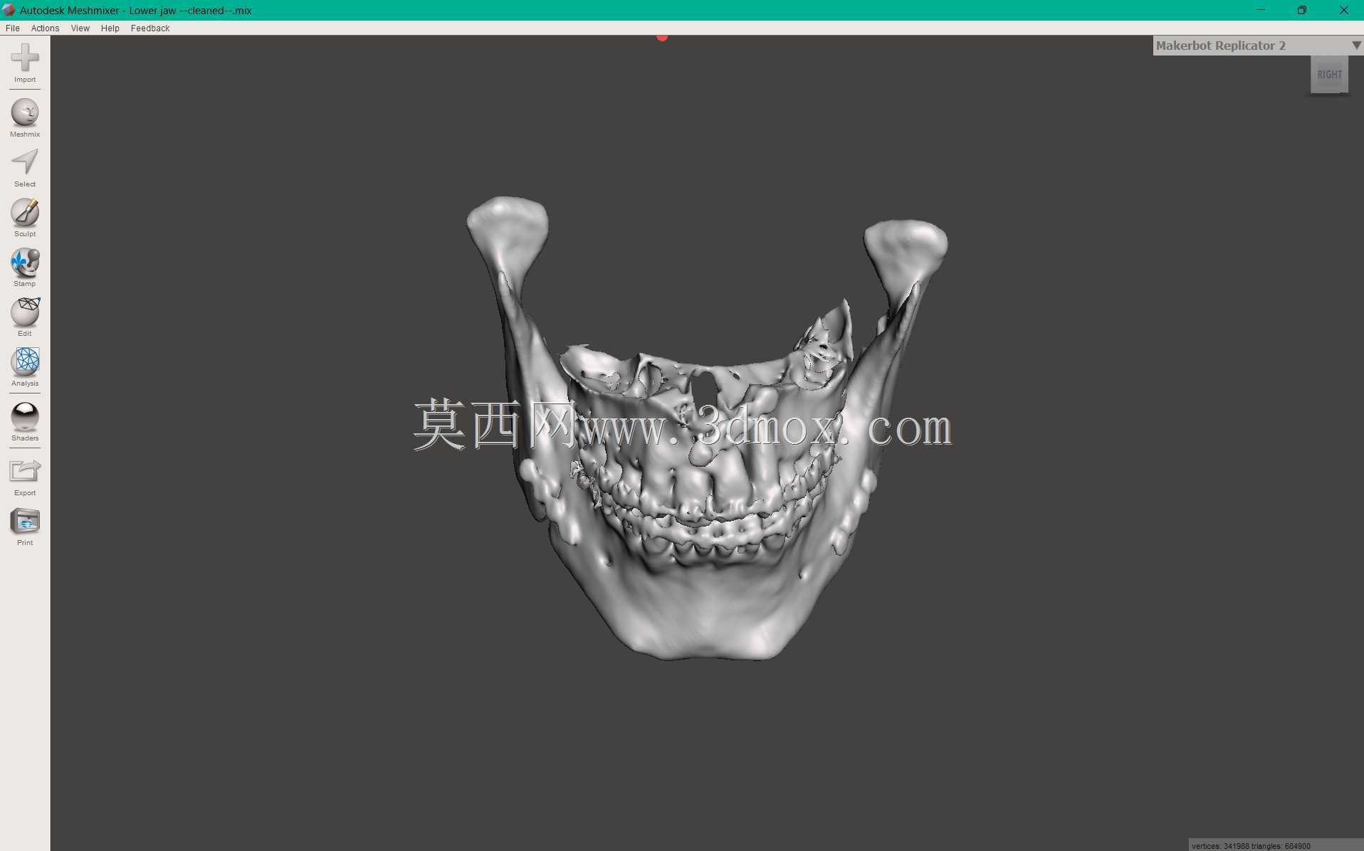 Bijaw手术后的上颌和下颌