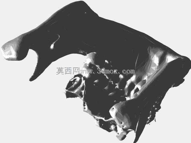 Bijaw手术后的上颌和下颌
