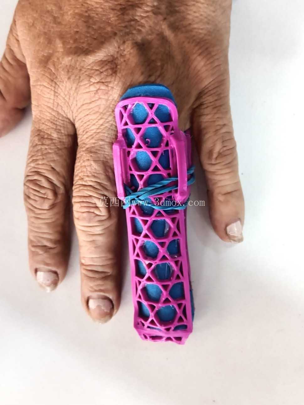 手指矫形器-可热成型3D打印