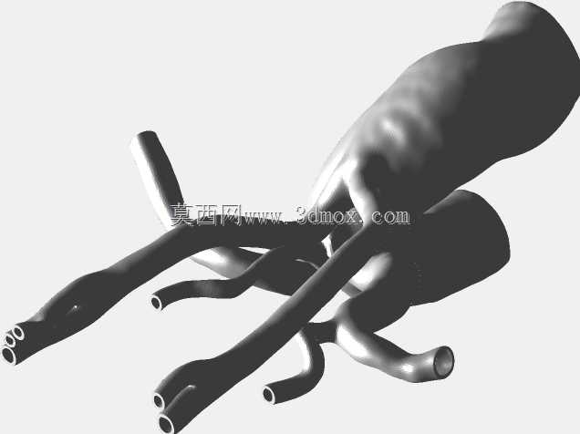 主动脉弓伴双颈动脉干异常