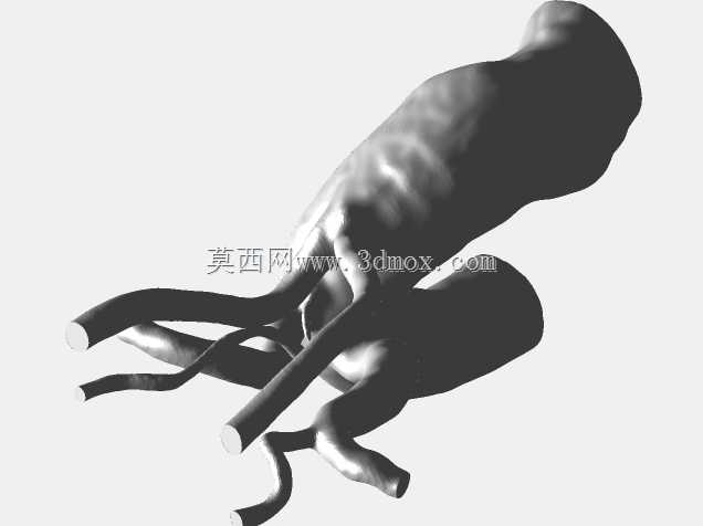 主动脉弓伴双颈动脉干异常