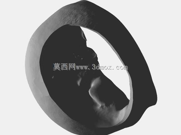 医学培训师-脑膜瘤切除术颅骨