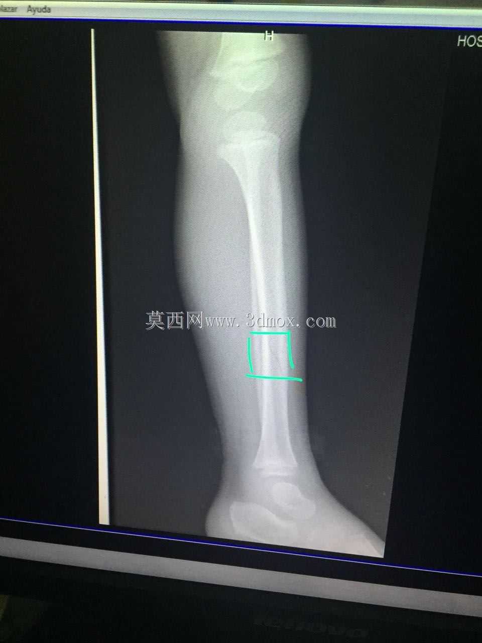 前列腺阿魏