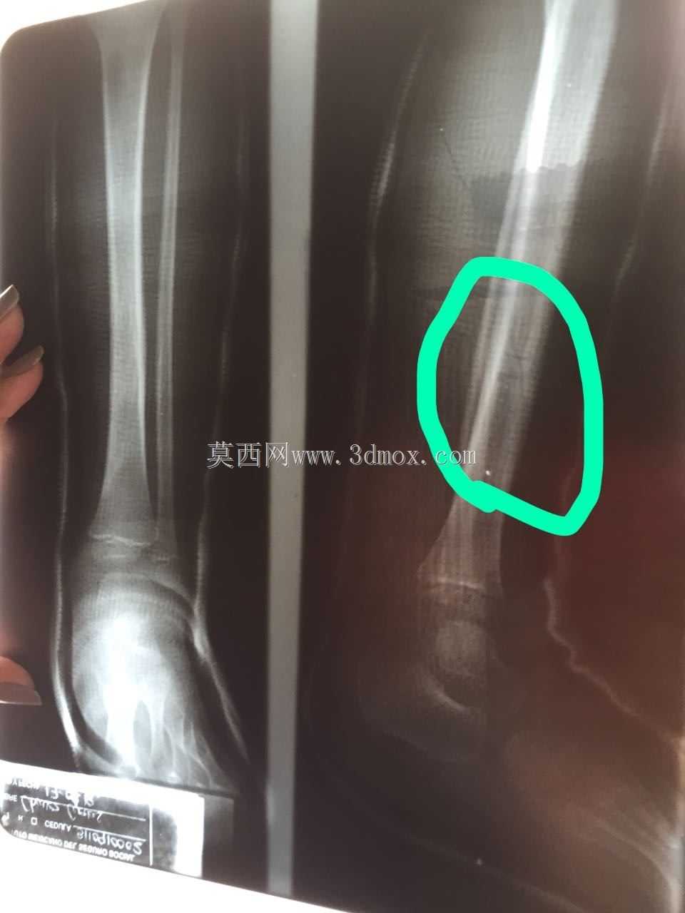 前列腺阿魏
