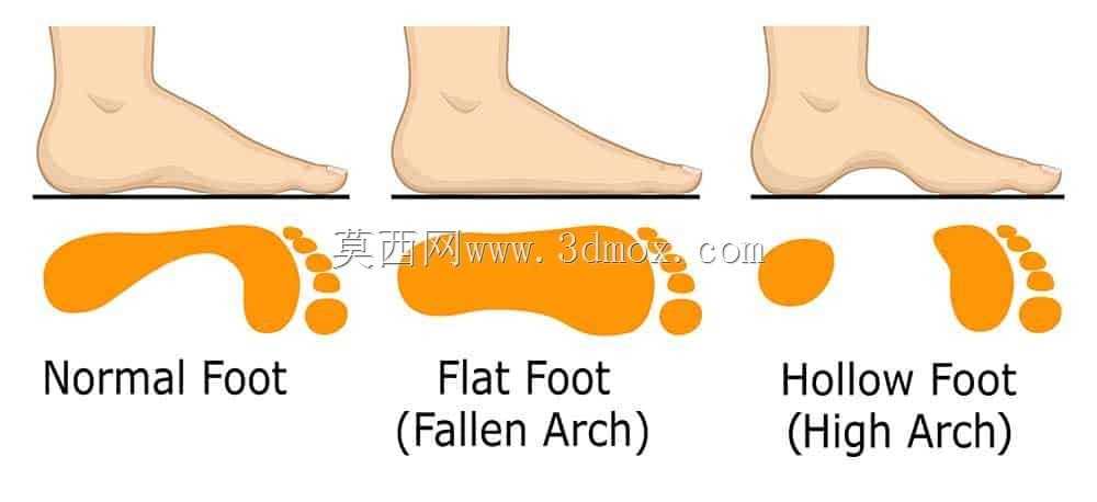踝足矫形器(AFO)