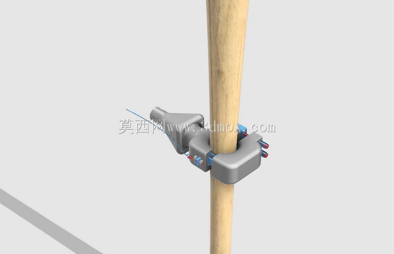 用于假肢的棒球棒支架