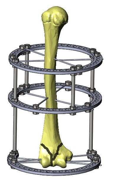 �������ۧ��ӧ� �ӧߧ֧�ߧ֧� ��ڧܧ�ѧ�ڧ�. �����ѧ�ѧ� ���ݧڧ٧ѧ��ӧ�. ��̶�װ�ã��ǣ���Ilizarovװ��