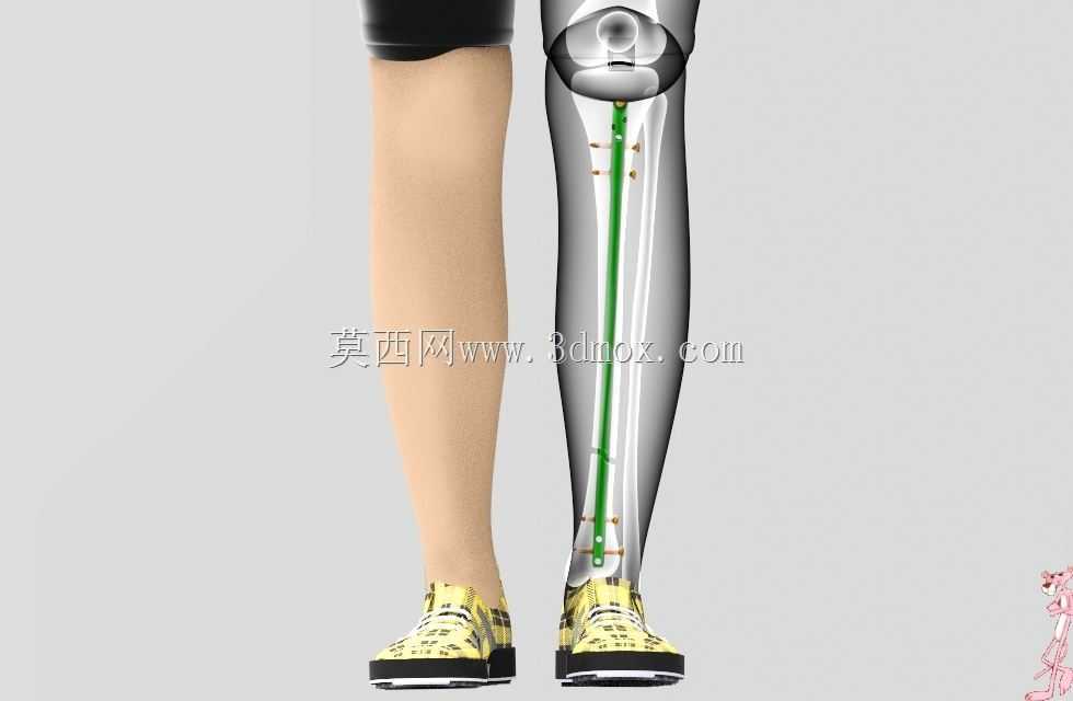 胫骨髓内钉