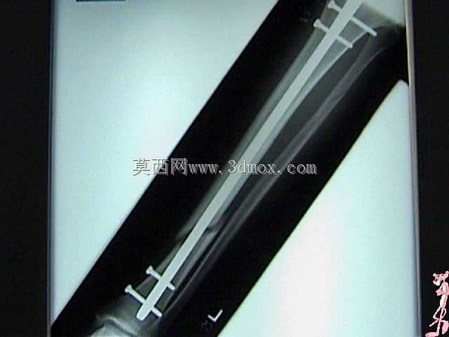 胫骨髓内钉