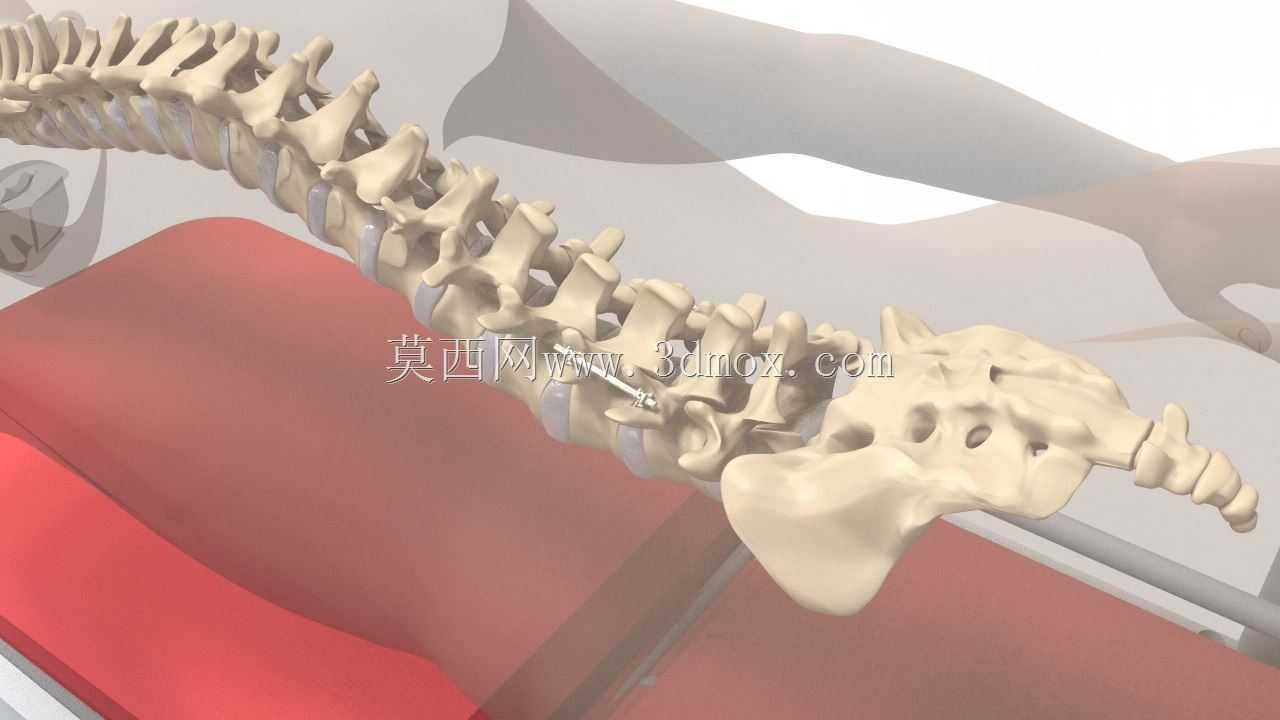 脊柱固定器