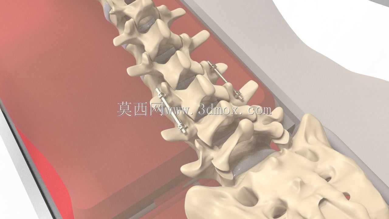 脊柱固定器