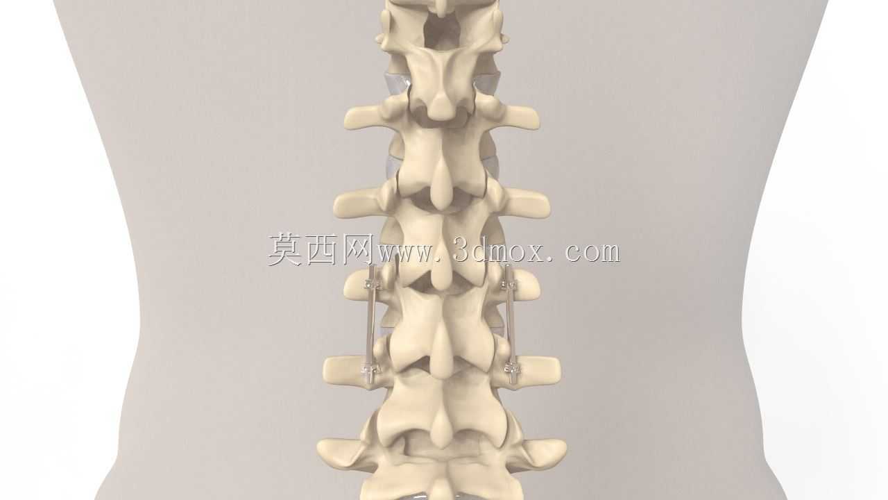 脊柱固定器