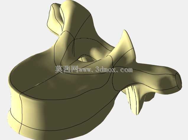 脊柱固定器