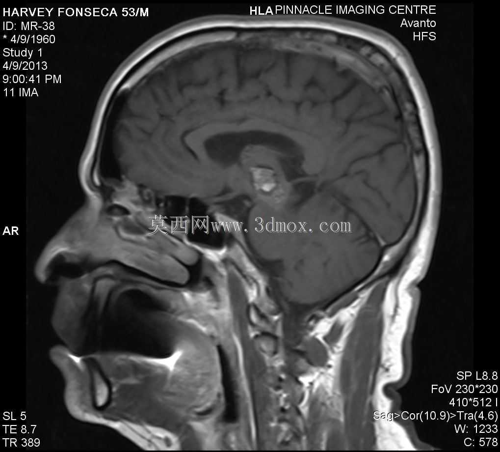 ���Եĺ���״Ѫ����\u0026 Autocad 3D�е�­��