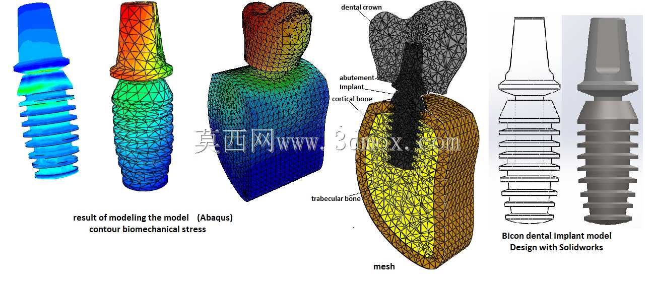 Bicon牙种植CAD