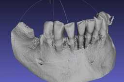 MandibuleDICOM1
